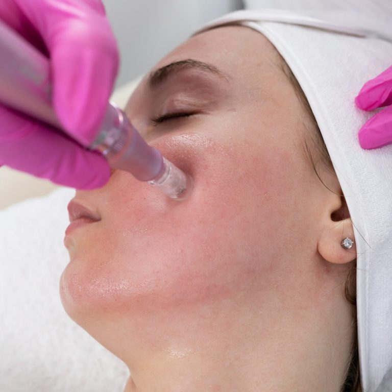 Microneedling stimuleert de natuurlijke aanmaak van collageen en elastine voor een stevigere en egalere huid.