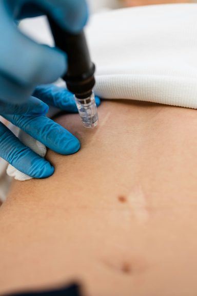 Microneedling voor littekens